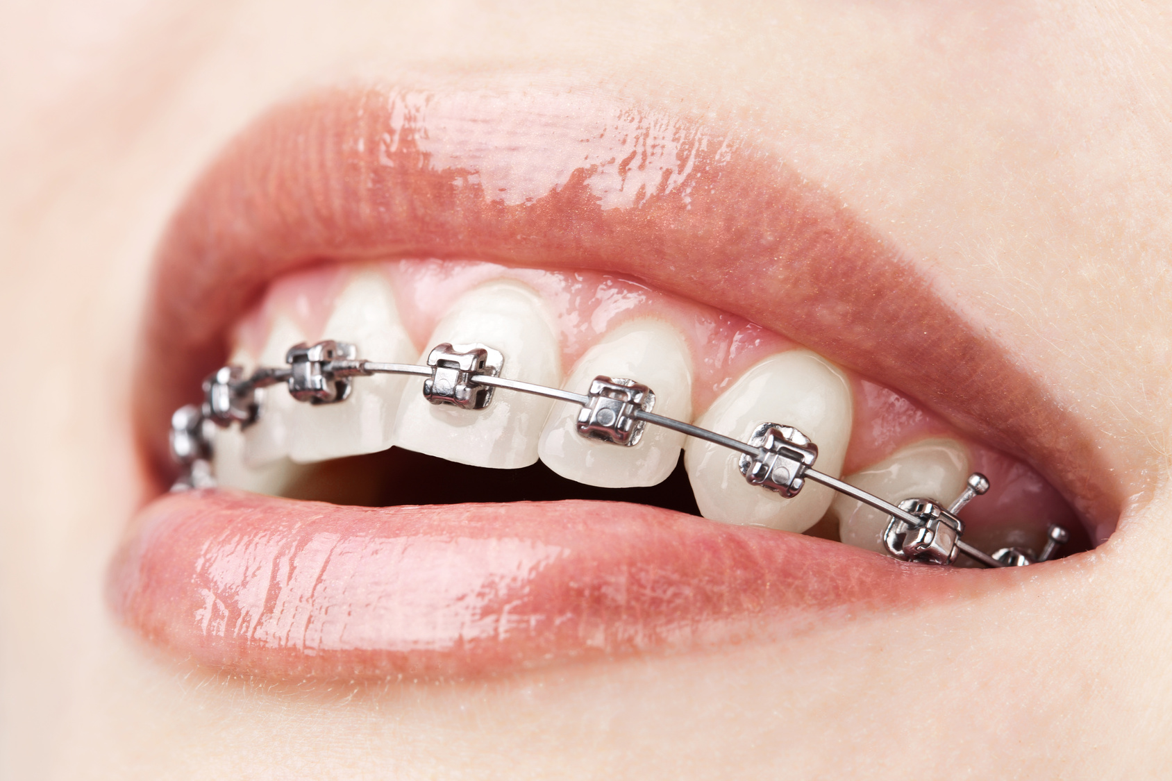 Orthodontics Australia  What to Do When Your Braces Wire Breaks?